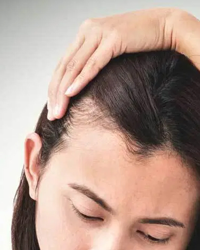 Hair Loss Treatment Dubai